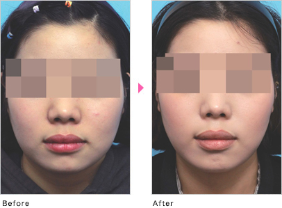 顔やせ 小顔注射 Bnls Neo 小顔輪郭注射 北九州の美容外科 美容皮膚科 さくらビューティクリニック