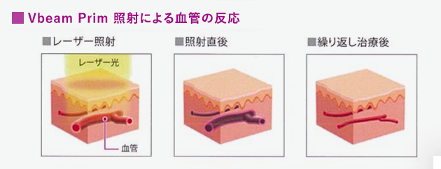 深達性に優れた波長2