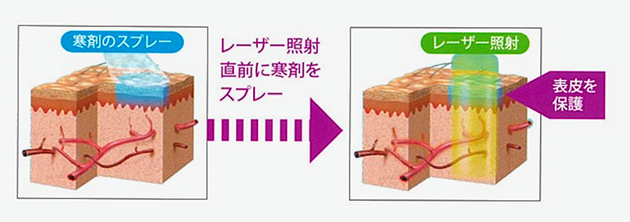 優れた皮膚冷却機能